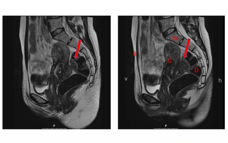 Kernspintomographie (MRI): Tief-infiltrierende Endometriose mit Befall der Darmwand (roter Pfeil); v: vorne, h: hinten, B: Bauchwand, G: Gebärmutter, D: Darm, W: Wirbelsäule.