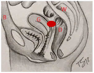 Skizze analog zum MRI: Typische Lokalisation bei tief-infiltrierender Endometriose zwischen Gebärmutter und Enddarm. 