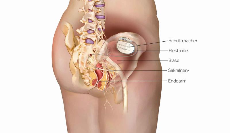 Der Blasenschrittmacher wird unter der Haut im Bereich des Kreuzbeines eingesetzt. 