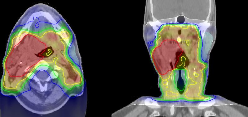 Irradiation plan of a head and neck tumor