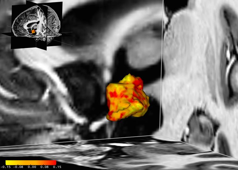 Bei Depressionen und bipolarer Störung sind einige Regionen des Hypothalamus vergrößert (rot), einige sind jedoch auch verkleinert (gelb).