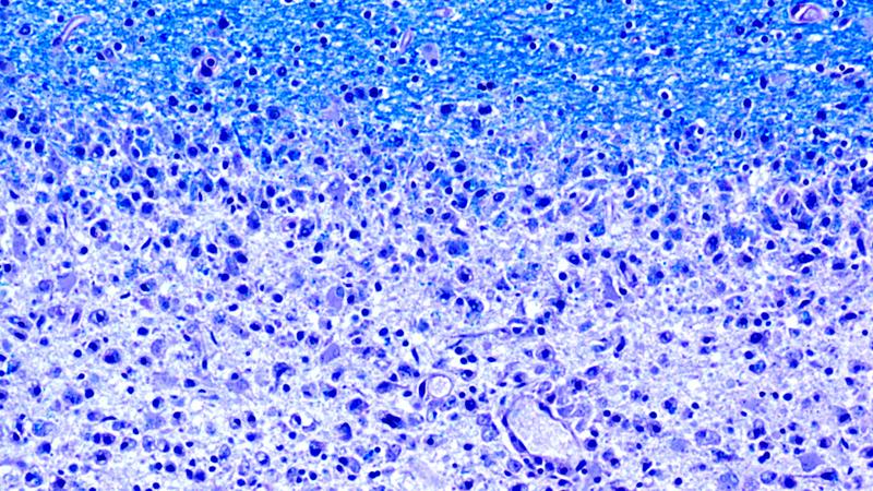 Schwindende Nervenhüllen: An den lädierten Stellen (unten im Bild) im Gehirn von MS-Patienten fehlt das Myelin (oben in blau).