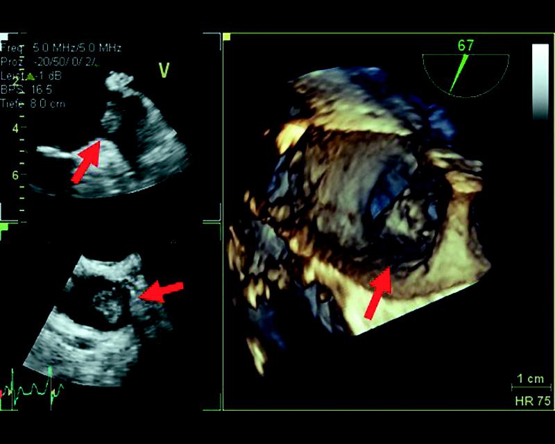 3D-Schluckechokardiographie (Ultraschall von der Speiseröhre): Darstellung eines kugeligen echodichten Thrombus im linken Vorhofohr (Pfeile).