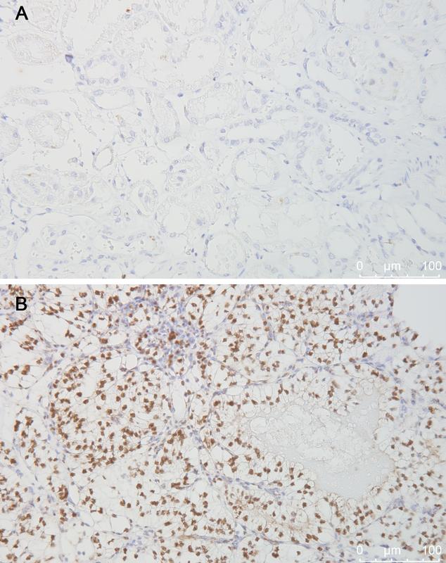 Immunhistochemische Färbung (braun) des Hypoxie-induzierbaren Faktors 1α (HIF1α) in normalem Nierengewebe (A) und einem Schnitt durch einen VHL-mutierten Nierentumor (B).