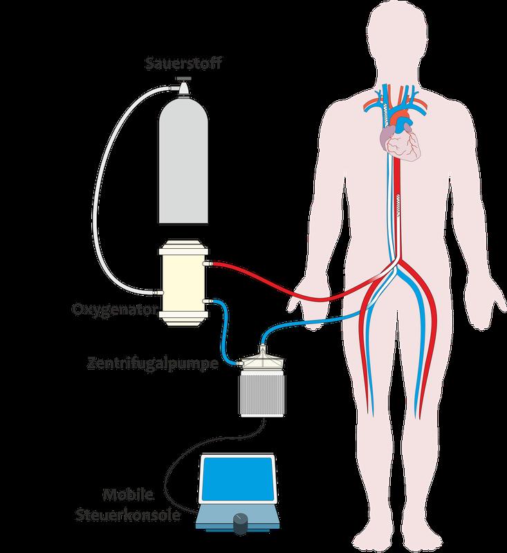 Schematische Darstellung Mobile Herz-Lungen-Maschine