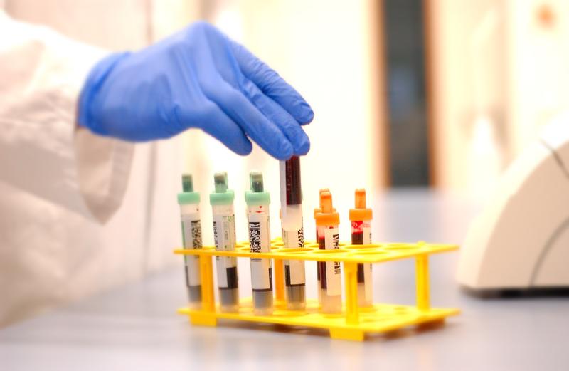 A blood test for the rapid diagnosis of Alzheimer’s disease