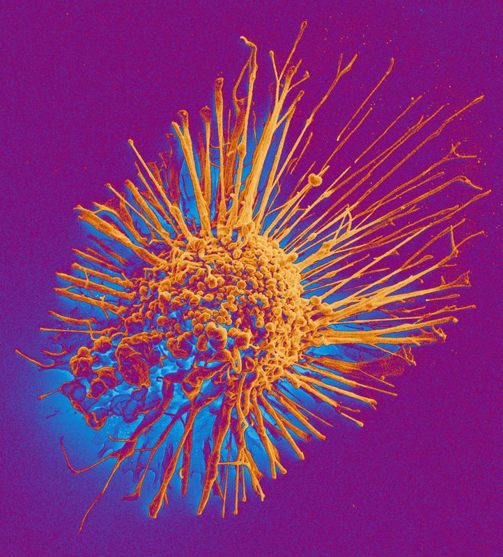 Scanning electron microscopy image of a cancer cell.