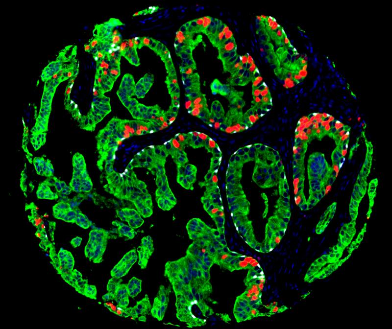 Schnitt durch das Gewebe einer Prostatabiopsie. Prostatazellen sind grün gefärbt, rote und weiße Bereiche stellen tumorrelevante Veränderungen in Prostatakrebszellen dar.