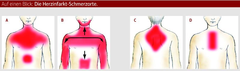 Die Herzinfarkt-Schmerzorte.