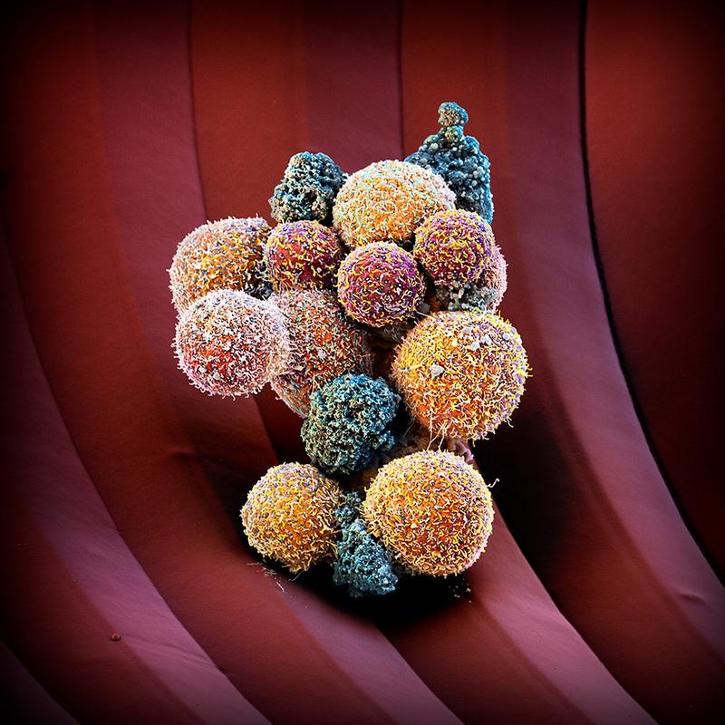Das Bild stellt einen kolorierten Tumorzellverband dar (CTC-Cluster), der aus dem Blut einer Patientin mit Brustkrebs isoliert wurde und auf einem Mikrochip eingefangen wurde. 