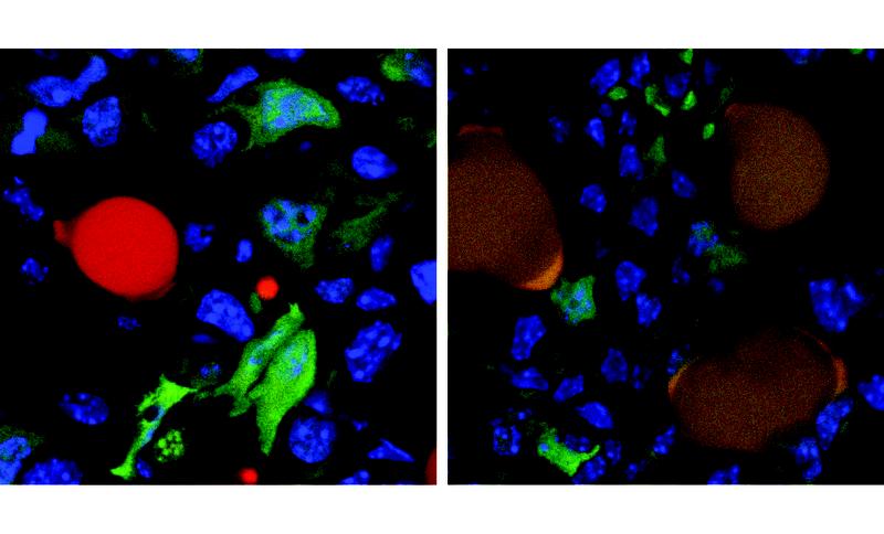 Krebszellen (grün) und eine rot markierte Fettzelle an der Oberfläche eines Tumors (links). Nach der Therapie (rechts) haben sich drei ehemalige Krebszellen in Fettzellen (dunkelgelb) umgewandelt. 
