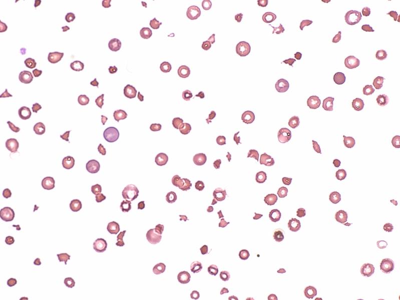 Blutbild bei TTP: Die roten Blutkörperchen wurden an den Blutgerinnseln verletzt (Halbmonde und Fragmente statt runder Blutkörperchen). Die Blutplättchen fehlen fast gänzlich.