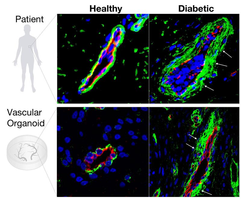 Diabetic blood vessel changes in patients and human vascular organoids The basement membrane (green) around the blood vessels (red) is massively enlarged in diabetic patients (white arrows).