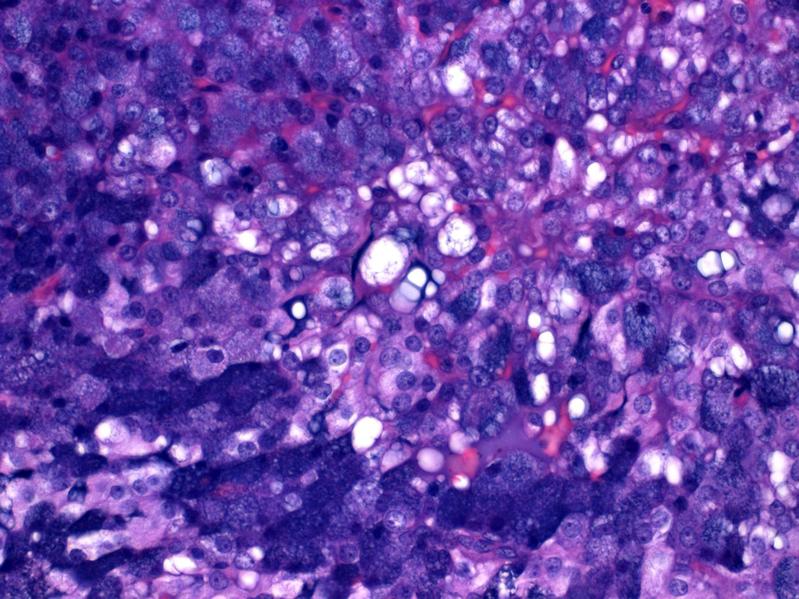 In der mikroskopischen Aufnahme erkennt man die charakteristischen serösen Speichelgranula in den Tumorzellen als blaue feinkörnige Strukturen im Zellleib. 