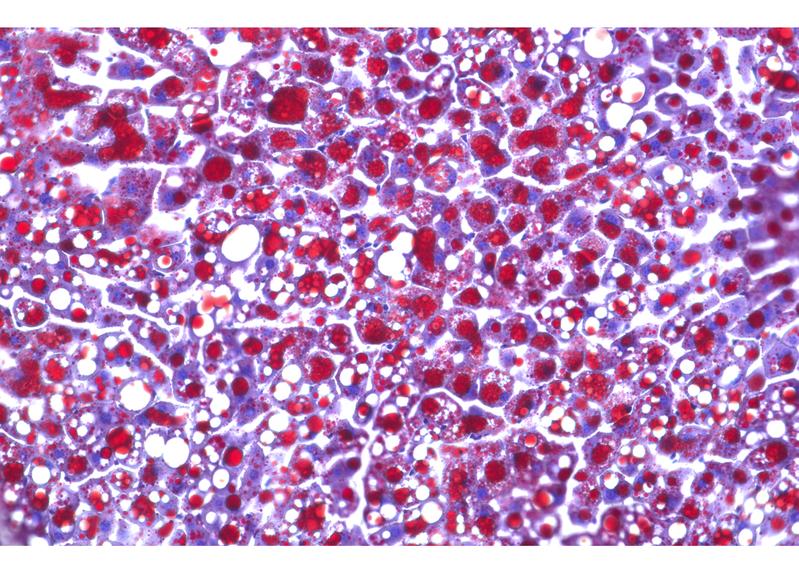 Steroid treatment can trigger metabolic changes such as a fatty liver (shown here) via the transcription factor E47. 