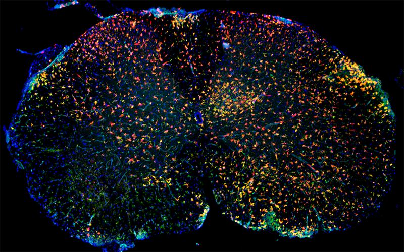 Immunfluoreszenz von entzündlich verändertem Rückenmark mit roten Mikrogliazellen und grünen aus dem Blut eingewanderten Makrophagen. 