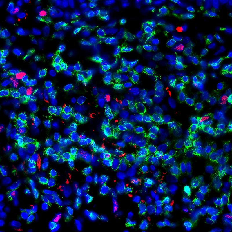 Die Immunfluoreszenz zeigt T-Helfer-Zellen (grün, CD4+) in der Haut eines Patienten mit starker allergischer Kontaktdermatitis. Einige davon exprimieren den Transkriptionsfaktor PPAR (rot)