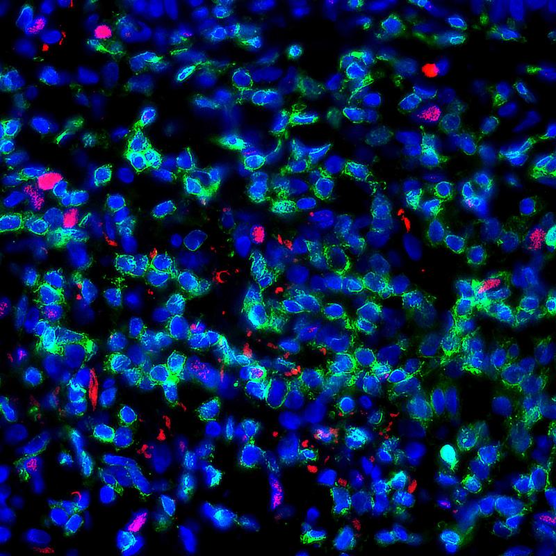 The immunfluorescence shows TH cells (in green, CD4+) in the skin of a patient with acute allergic contact dermatitis. Several of these cells express the transcription factor PPAR-γ (in red).