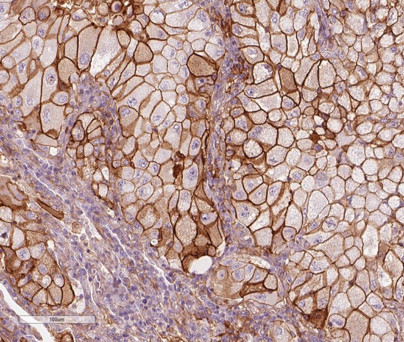Getarnte Krebszellen: Schüttet die Lungenkrebszelle PD-L1 aus, wird das Immunsystem gehemmt. Lungenkrebszellen mit PD-L1 sind braun gefärbt, die Immunzellen violett.
