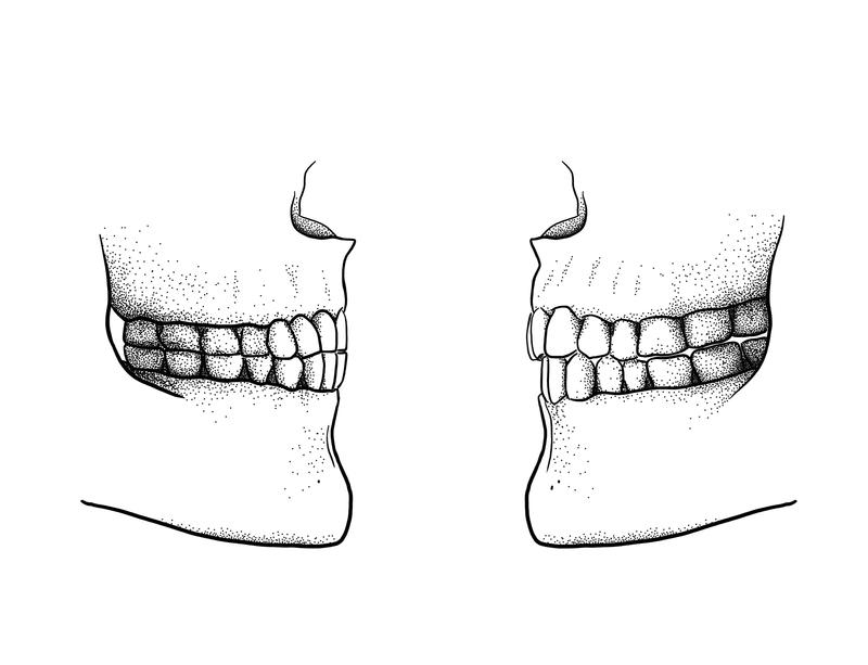 The difference between a Paleolithic edge-to-edge bite (left) and a modern overbite/overjet bite (right). (Image: Tímea Bodogán) 