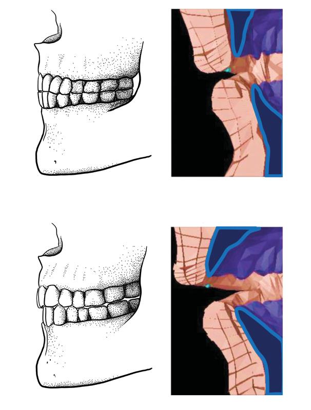 Paleolithic edge-to-edge bite (top) and a modern overbite/overjet bite (bottom) and how "f" sounds are produced in a biomechanical model. (Image: Tímea Bodogán) (Bild: Tímea Bodogán/Scott Moisik) 