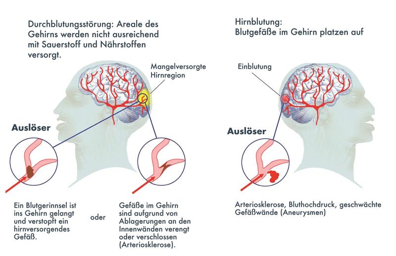 Ursachen des Schlaganfalls: Die meisten Schlaganfälle werden von einer Durchblutungsstörung im Gehirn verursacht.