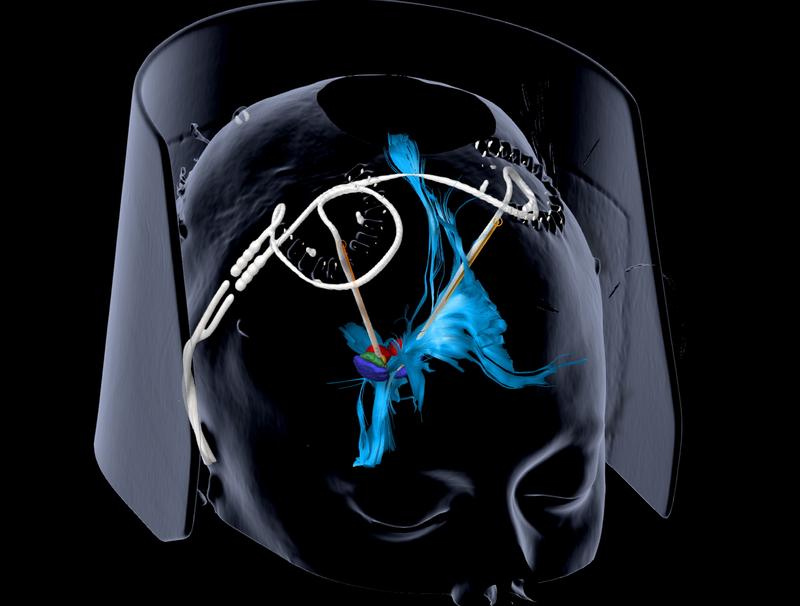 Mit zwei Elektroden stimulierten die Freiburger Ärzte bei schwerstdepressiven Patienten das mediale Vorderhirnbündel (blau), das an der Wahrnehmung von Freude und Belohnung beteiligt ist.