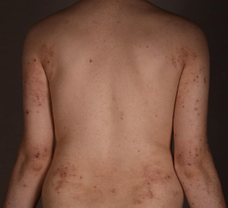 Rücken mit atopischer Dermatitis