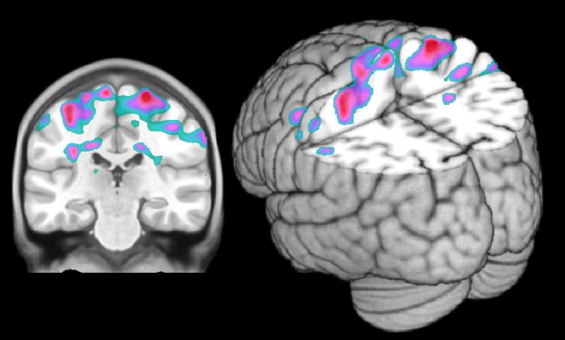 Höhere Aktivierung bei der Betrachtung der Trauerbilder in spezifischen Teilen des Spiegelneuronensystems (somatosensorische Areale) bei Borderline-PatientInnen in Vergleich zu Gesunden.
