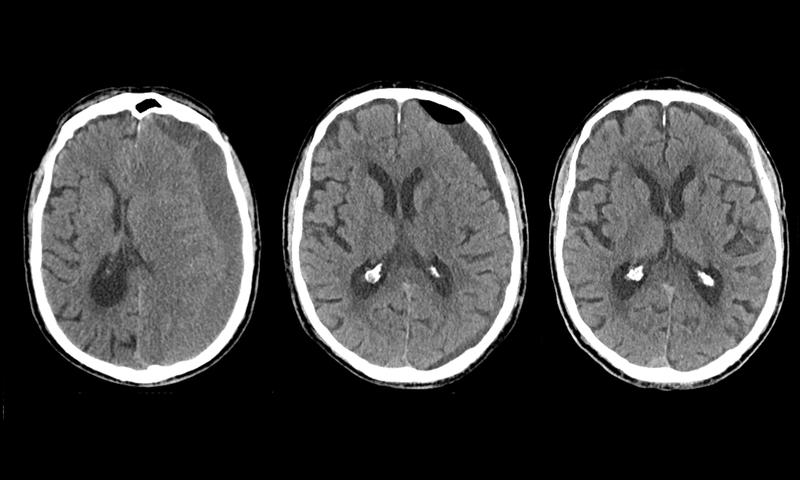 CT-Bilder eines Patienten mit chronischem Subduralhämatom: Vor der Operation (links), zwei Tage nach der Operation (Mitte) und ein Monat nach der Operation (rechts).