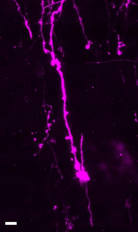 Menschliche basale Vorläuferzelle mit Fortsätzen. Die Zelle wurde mit einem lipophilen Farbstoff, DiI (Magenta), auf der basalen Seite des fötalen neokortikalen Gewebes nachgewiesen. Skala: 10 µm. 