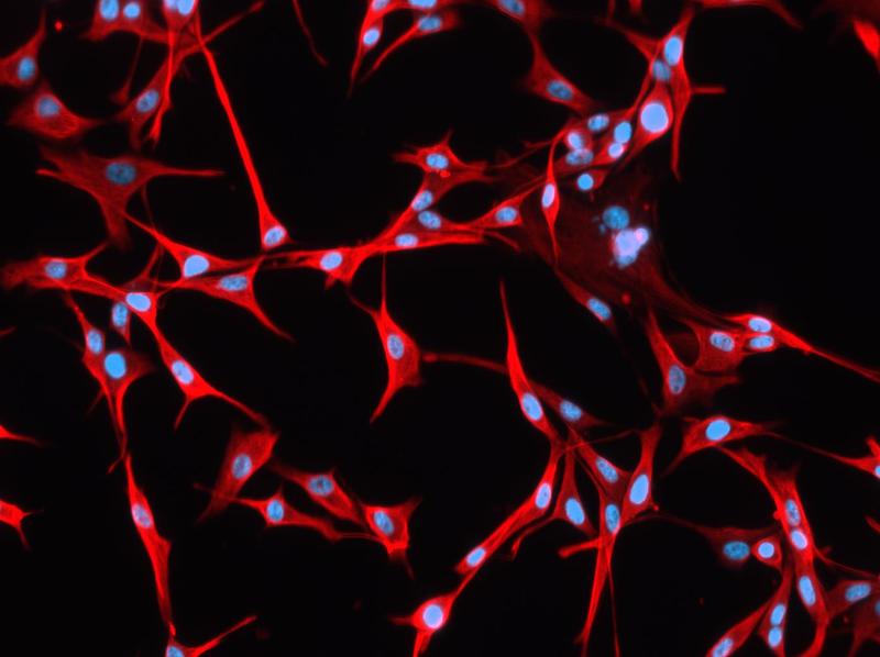 Zellkultur eines Glioblastoms: Blau sind die Zellkerne, rot die Zellkörper zu sehen