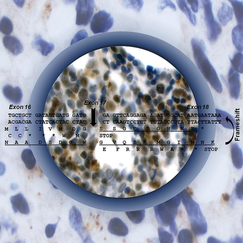 Schematische Darstellung der Entstehung der ASPP2kappa-Proteinvariante: Die spezifische Färbung im Zentrum der Grafik weist das Vorhandensein des ASPP2kappa-Proteins in Leukämiezellen nach.