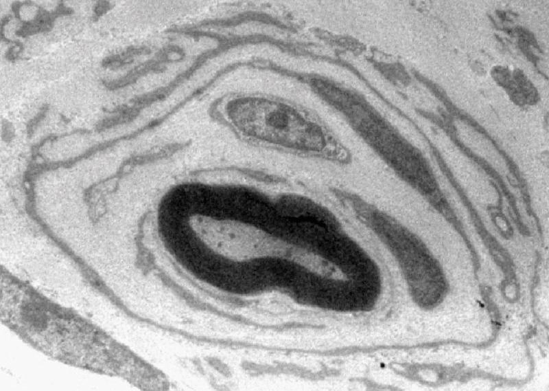 Elektronenmikroskopische Aufnahme eines an CMT1A erkrankten Nervs im Querschnitt. An die innere mit Myelin (schwarzer Ring) ummantelte Nervenfaser lagern sich mehrere Schwann-Zellen an