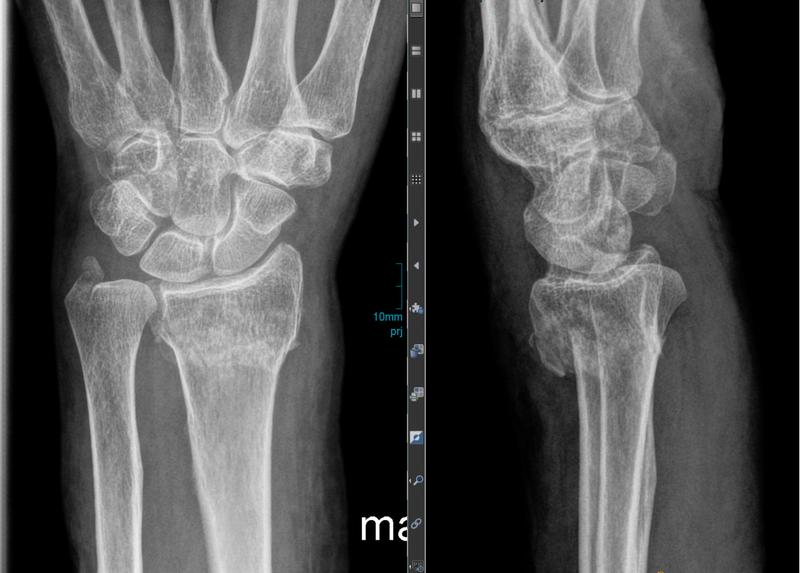 Röntgenaufnahme einer Unterarmfraktur 