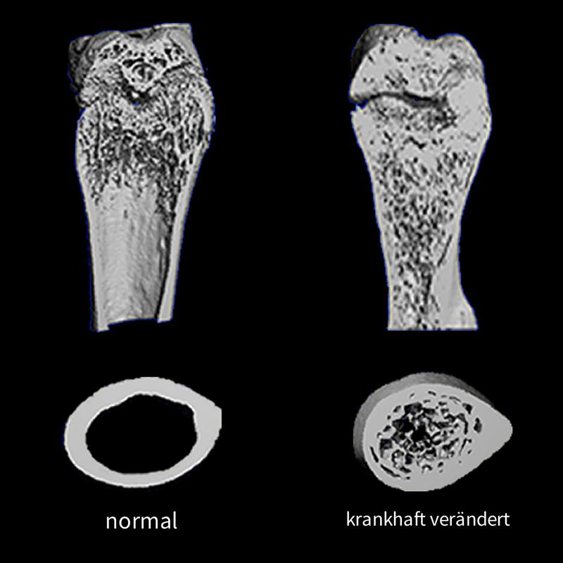 Bei der Marmorknochenkrankheit (Osteopetrose) wird durch fehlerhafte knochenabbauende Zellen (Osteoklasten) stetig Knochengewebe angehäuft (r.), so dass die Mikroarchitektur des Knochens gestört ist.