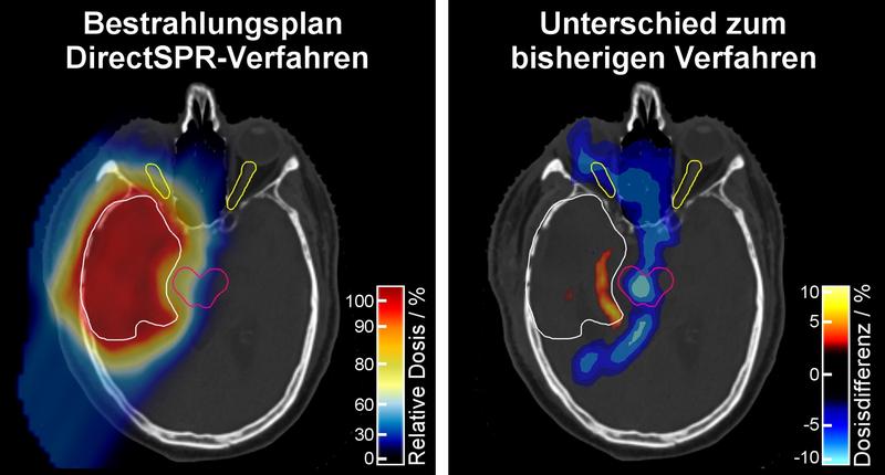 Der mit dem DirectSPR-Verfahren angefertigte Bestrahlungsplan (links) weist im Vergleich zum bisherigen Verfahren eine deutliche Dosis-Reduzierung im um den Tumor befindlichen gesunden Gewebe auf.