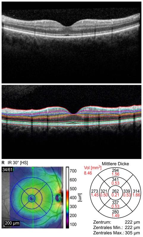 Makulascan mit aufeinanderfolgender Einzelschichtanalyse des rechten Auges 