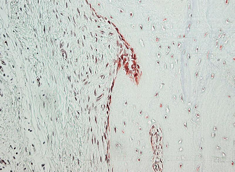  Entzündetes Kniegewebe: Unter dem Mikroskop wurden bestimmte Dopamin-Rezeptoren (rot) sichtbar gemacht. Links: Die Zellen der Gelenkschmiere, die bei einer RA Knorpel und Knochen (rechts) angreifen. 