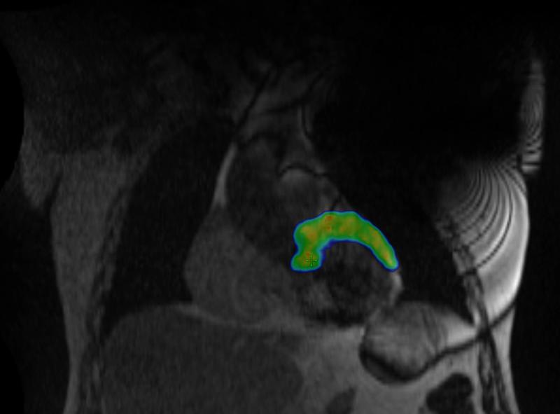 Unter MRI Bildgebung wurde der betroffene Anteil des Herzmuskels gezielt bestrahlt (in Farbe).