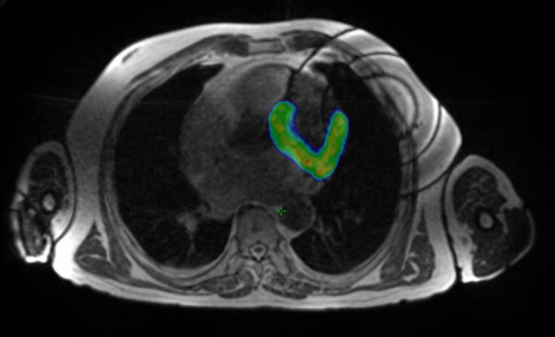 Unter MRI Bildgebung wurde der betroffene Anteil des Herzmuskels gezielt bestrahlt (in Farbe).
