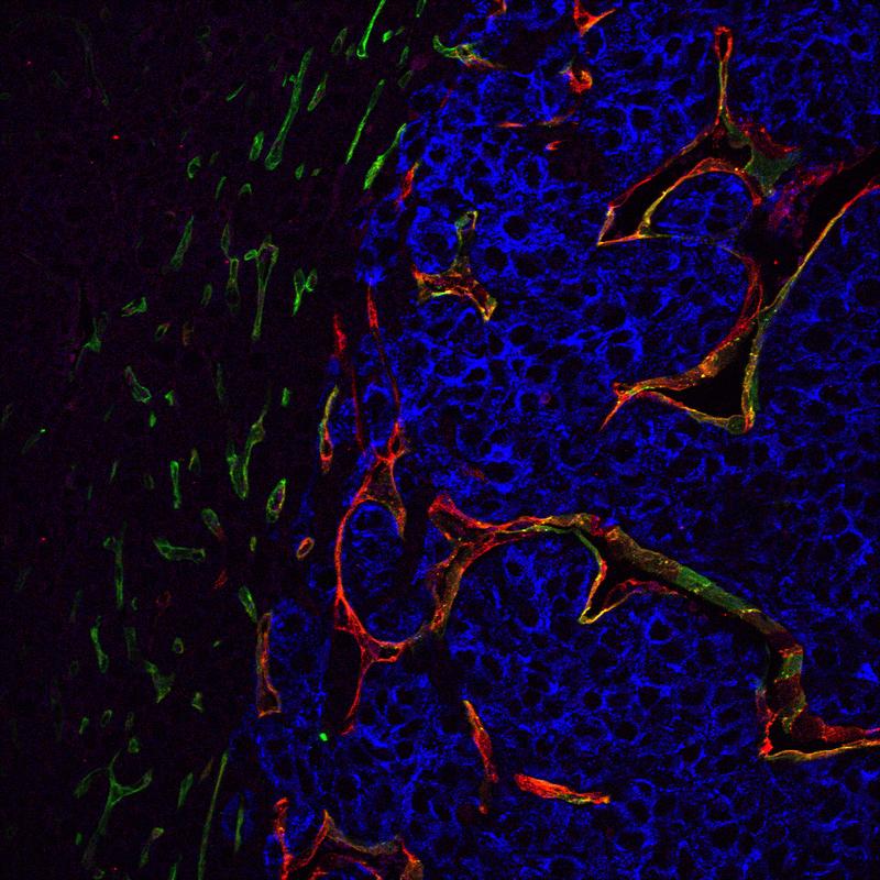 Immunfluoreszenz-Färbung von Lebergewebe mit einer Melanommetastase zur Darstellung der Tumorblutgefäße (rot/gelb).