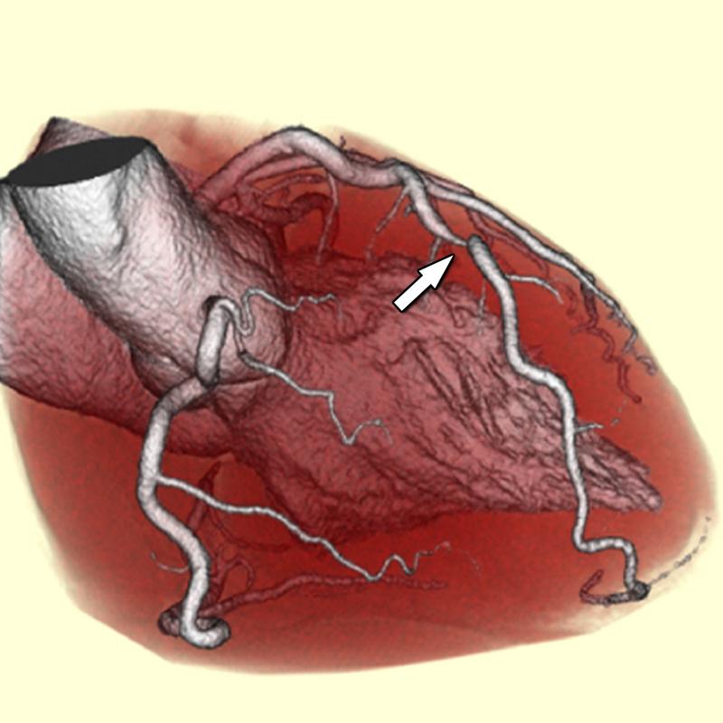 ei der Herz-CT werden tausende Röntgenaufnahmen des Herzens zu einer 3D-Abbildung verrechnet. So werden Engstellen (Pfeil) an Blutgefäßen (grau) sichtbar.