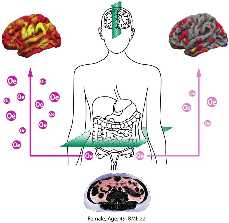 Increased organ fat (scan below) accelerates ageing of brain structural networks - oestradiol (Oe) appears to protect women's brains from structural damage (brain structure top right) during midlife.