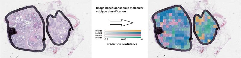 The image-based consensus molecular subtypes (imCMS) model can be used to predict the molecular classification of each individual image region in patient tumor samples. 
