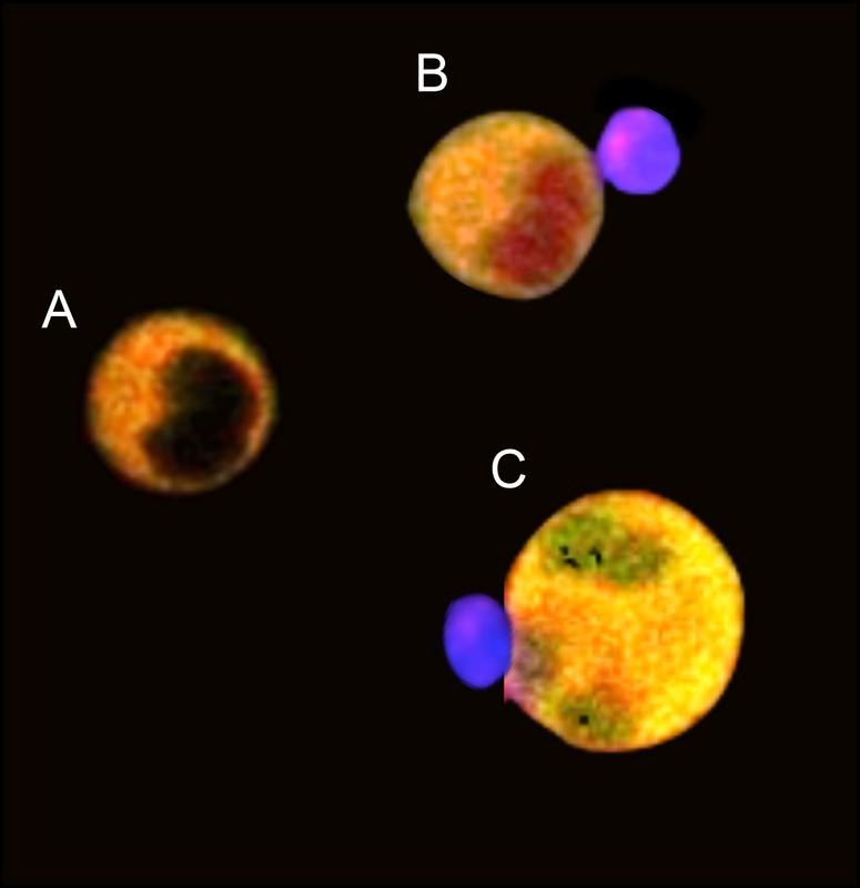 Tumorzellen mit Fluoreszenzmarker(gelb), Zellkern bei lebenden Zellen ungefärbt (A). Wenn NK-Zellen (lila) die Tumorzellen umbringen, färbt sich je nach Angriffsweg der Zellkern rot (B) oder grün (C)