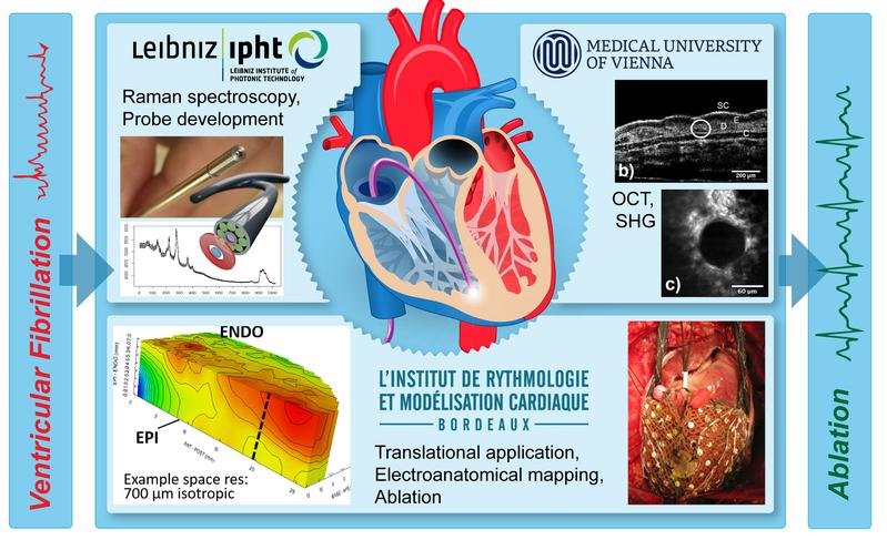 Im Projekt MultiFib arbeitet das Leibniz-IPHT mit der Medizinischen Universität Wien und dem Institut für Rhythmologie und Herzmodellierung (Liryc) in Bordeaux zusammen.