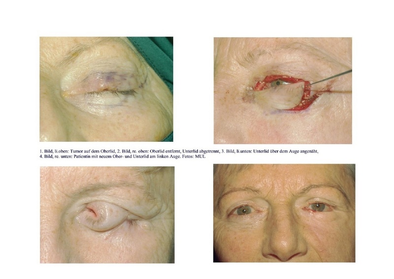 Oberlidrekonstruktion in vier Schritten: Tumor auf dem Oberlid; Oberlid entfernt, Unterlid abgetrennt; Unterlid über dem Auge angenäht; Patientin mit neuem Ober- und Unterlid am linken Auge