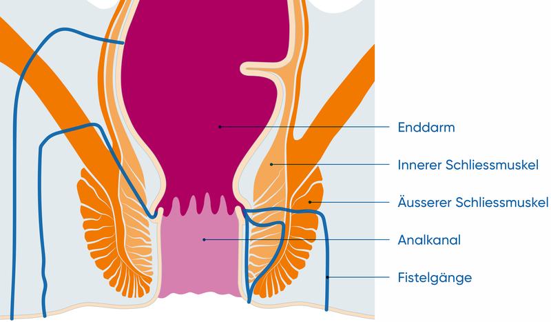 Analfisteln sind krankhafte Gänge, die den Analkanal mit der  Körperoberfläche am After verbinden.