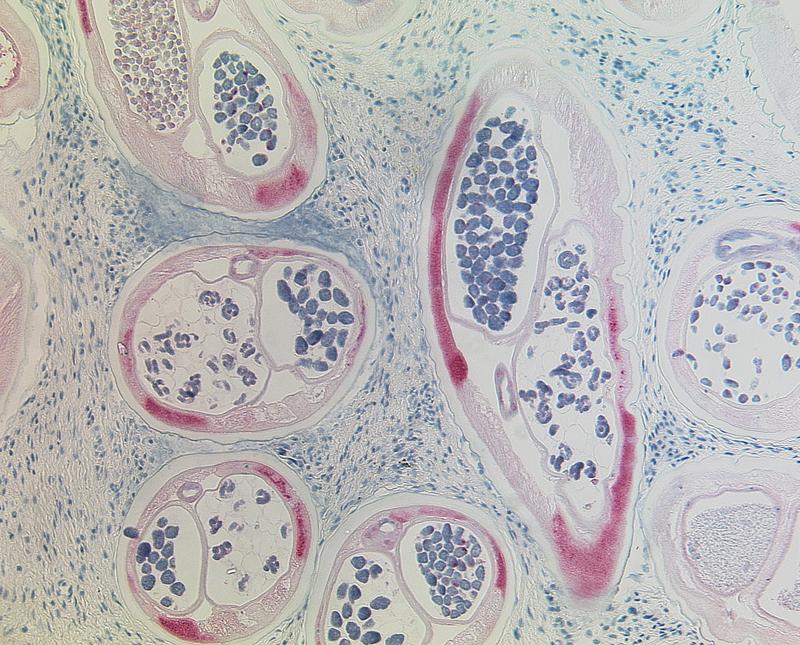 Histologischer Schnitt von Onchocerca volvulus unter dem Mikroskop: Querschnitte eines lebenden weiblichen Wurms mit Nachkommen in den Gebärmuttern. Die symbiotischen Bakterien sind stark rot gefärbt